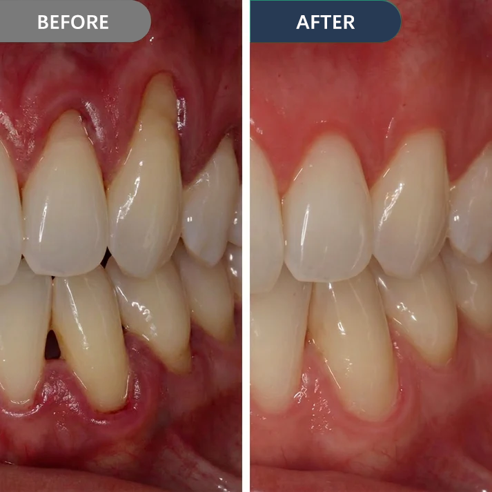 SmileFitPro™ Precision Gum Care Gel – Daily Support for Sensitive, Tender & Bleeding Gums