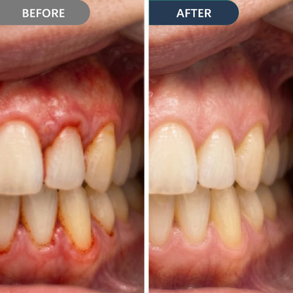 SmileFitPro™ Precision Gum Care Gel – Daily Support for Sensitive, Tender & Bleeding Gums